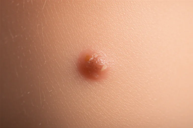 Featured image for Skin Cancer Self Removal 7 Critical Reasons to Avoid DIY 2025